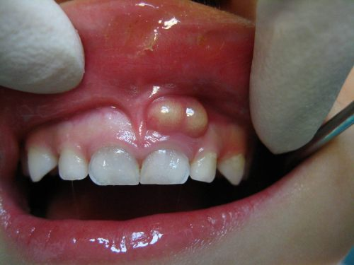 áp xe chân răng là gì