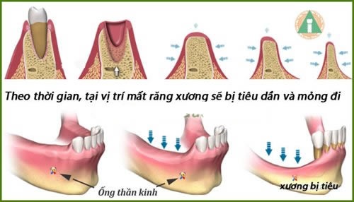 Trồng răng implant bảo vệ xương hàm một cách khỏe mạnh