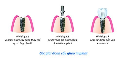 Image result for Kiến Thức Tổng Quát Về Implant Nha Khoa