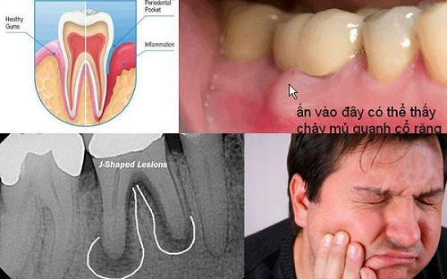 dấu hiệu của áp xe chân răng