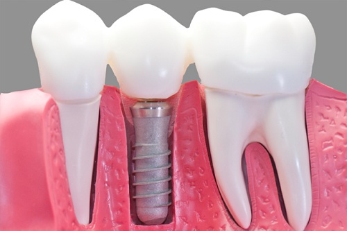 Image result for răng sứ tren implant