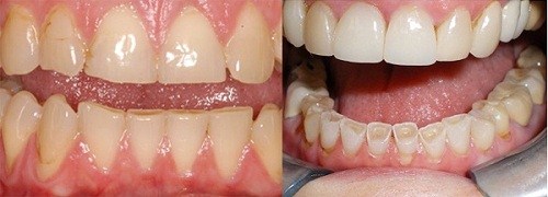 Nghiến Răng Là Gì -5