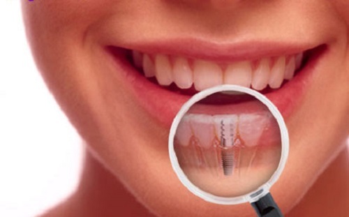 trồng răng implant giải pháp phục hồi răng vĩnh viễn