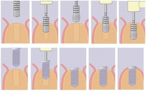 quy trình trồng răng implant như thế nào 4