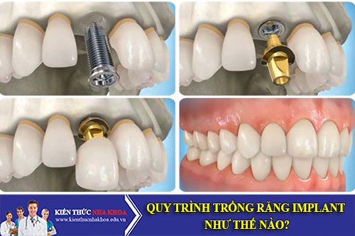 quy trình trồng răng implant như thế nào