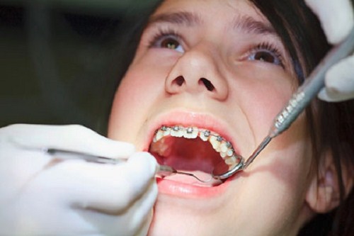 thời gian hoàn thành quá trình niềng răng là bao lâu 1