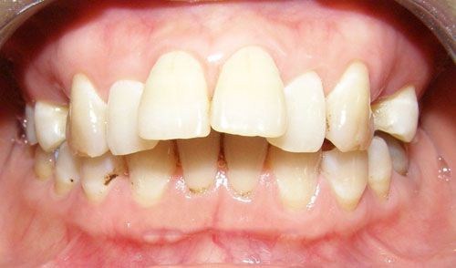 thời gian hoàn thành quá trình niềng răng là bao lâu 2