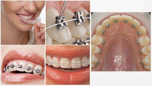 thời gian hoàn thành quá trình niềng răng là bao lâu 3