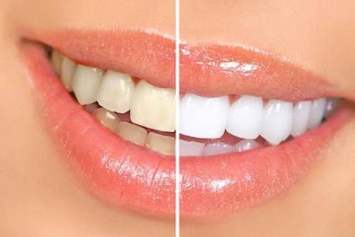 tổng quan về phương pháp tẩy trắng răng 2