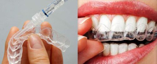 tổng quan về phương pháp tẩy trắng răng 3