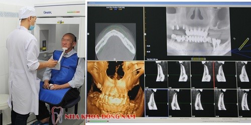 Trồng răng implant tại nha khoa Đông Nam 8