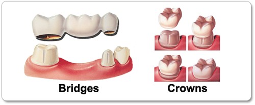 trồng răng sứ kim loại sử dụng được bao lâu 1