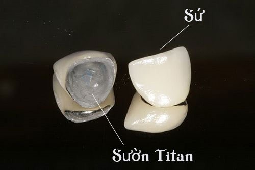 trồng răng sứ kim loại sử dụng được bao lâu 3