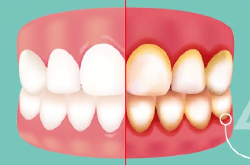 Tủy Răng Là Gì -5