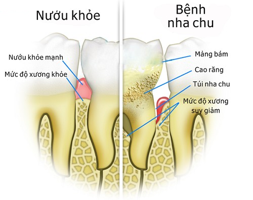 Image result for bá»‡nh nha chu