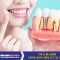 Top 20 Địa Điểm Trồng Răng Implant Tại TPHCM