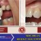 Trồng Implant khi bị mất 1 răng có được không?