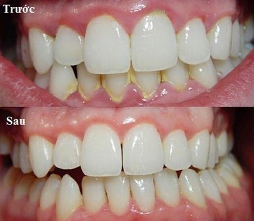 Cạo vôi răng giữ răng luôn sạch sẽ, ngăn ngừa vi khuẩn