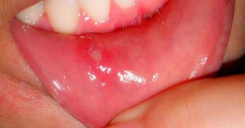 bệnh nhiệt miệng là gì? nguyên nhân gây bệnh như thế nào 5