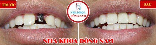 Trồng răng cửa loại nào tốt 1