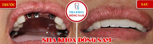 Trồng răng cửa loại nào tốt?