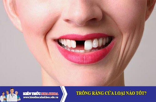 Trồng răng cửa loại nào tốt?