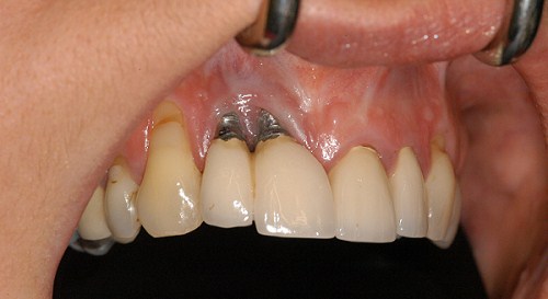 bị tiêu xương có trồng răng implant được không 2