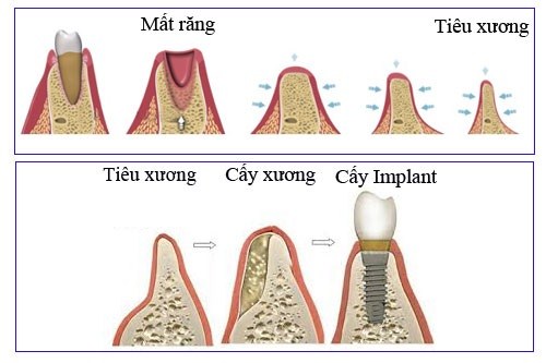 bị tiêu xương có trồng răng implant được không 3
