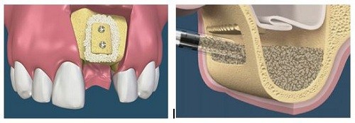 bị tiêu xương có trồng răng implant được không