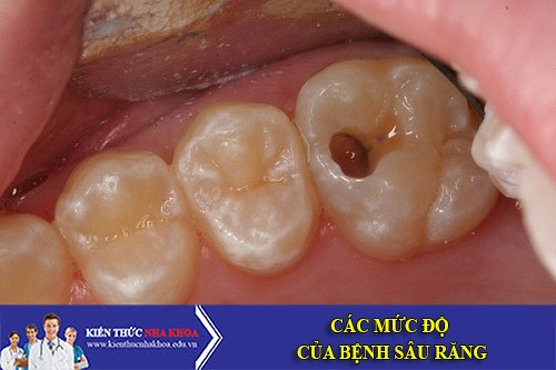 Các Mức Độ Của Bệnh Sâu Răng -1