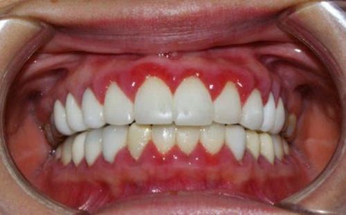 các vấn đề thường gặp sau khi trồng răng sứ và cách khắc phục 2