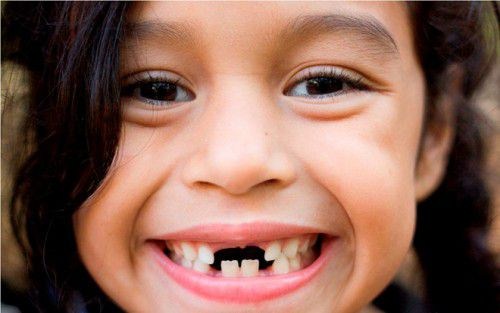 cách chữa sâu răng trẻ em như thế nào 2