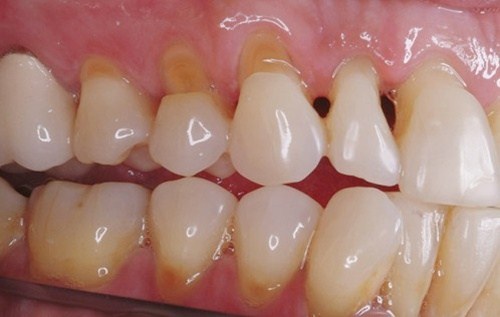 nguyên nhân và cách giảm ê buốt răng khi tẩy trắng 1