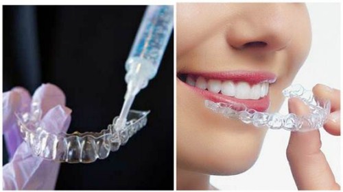 nguyên nhân và cách giảm ê buốt răng khi tẩy trắng 5