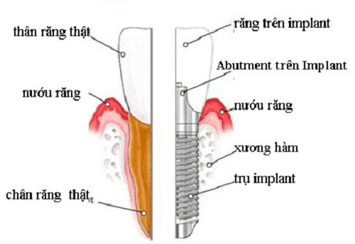 răng implant
