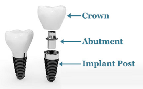 cấu tạo răng implant