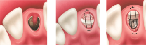 cấy ghép implant sau khi nhổ răng