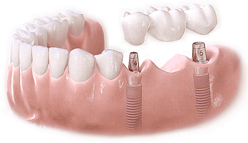 cấy ghép implant sau khi nhổ răng