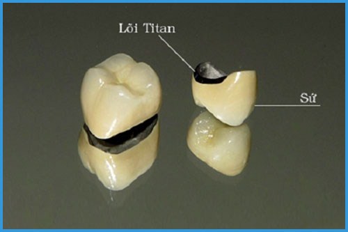 Bọc răng sứ Titan trắng sáng tự nhiên