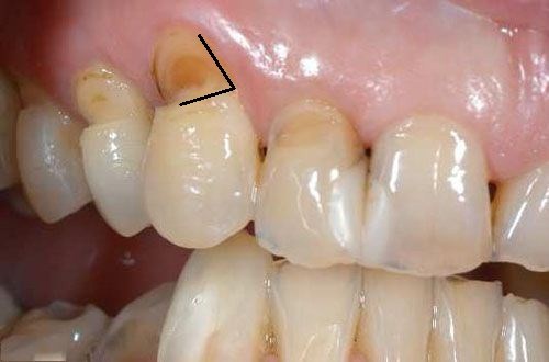 Có Bị Mất Răng Không Khi Khuyết Cổ Răng -2