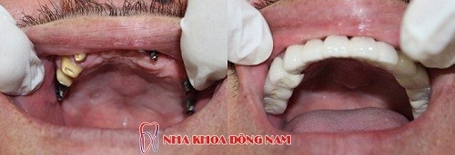 Cấy ghép răng Implant cho toàn hàm trên