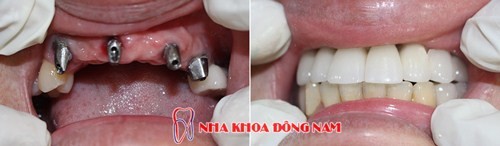 Cấy Implant phục hình răng cửa bị mất