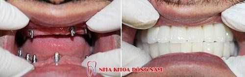 Cấy ghép Implant cho cả 2 hàm răng bị mất