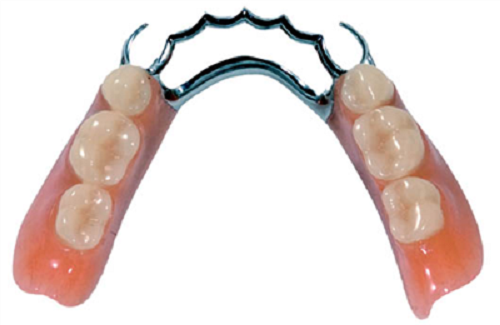 hàm răng giả tháo lắp bằng kim loại