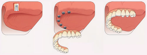 ham thao lap tren implant