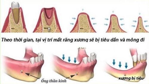 Không trồng răng giả sau khi nhổ răng có sao không 10