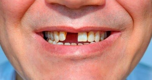 Không trồng răng giả sau khi nhổ răng có sao không 2