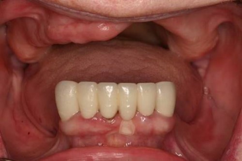 Không trồng răng giả sau khi nhổ răng có sao không 4