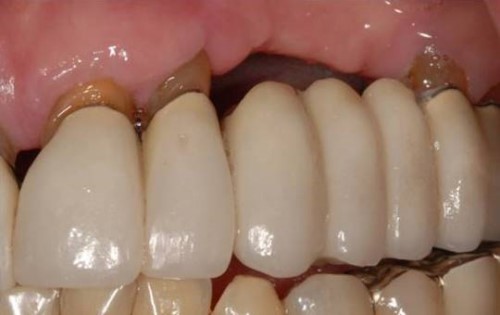 Không trồng răng giả sau khi nhổ răng có sao không 7