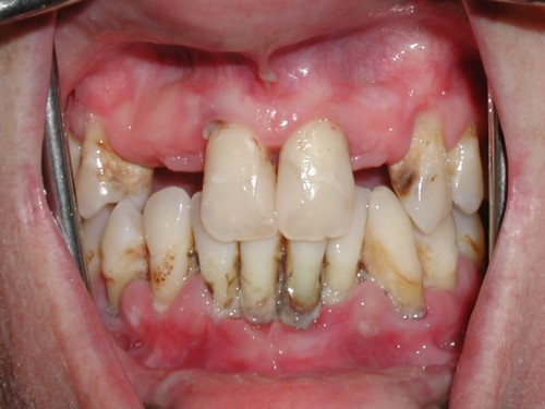 Bệnh nha chu không được chữa trị làm mất răng